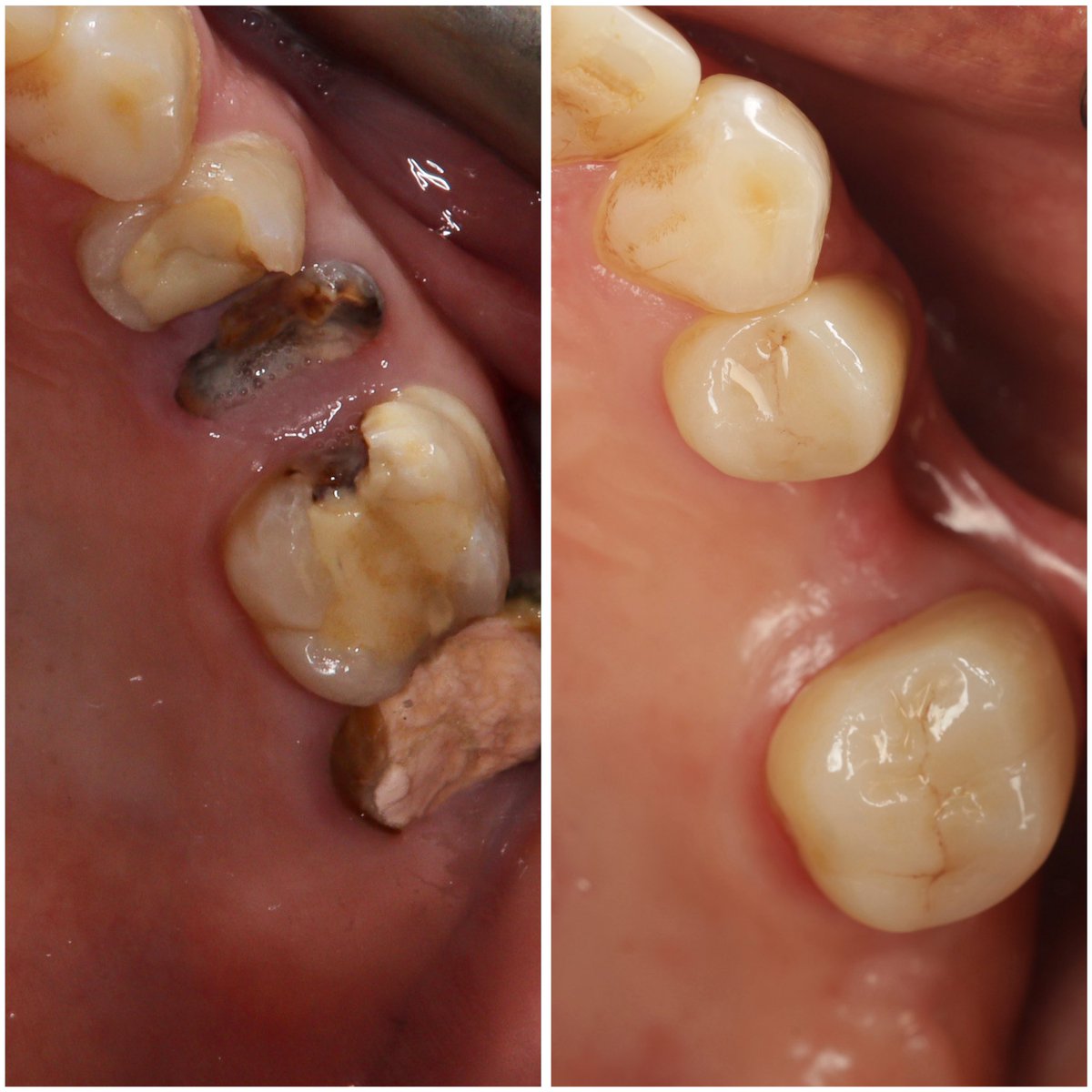 Reea3m's tweet photo. Both tooth #14 and tooth #17 have been restored with zirconia crowns. An implant for tooth #15 is planned and will be placed soon. https://t.co/gFb2GcJ1hp