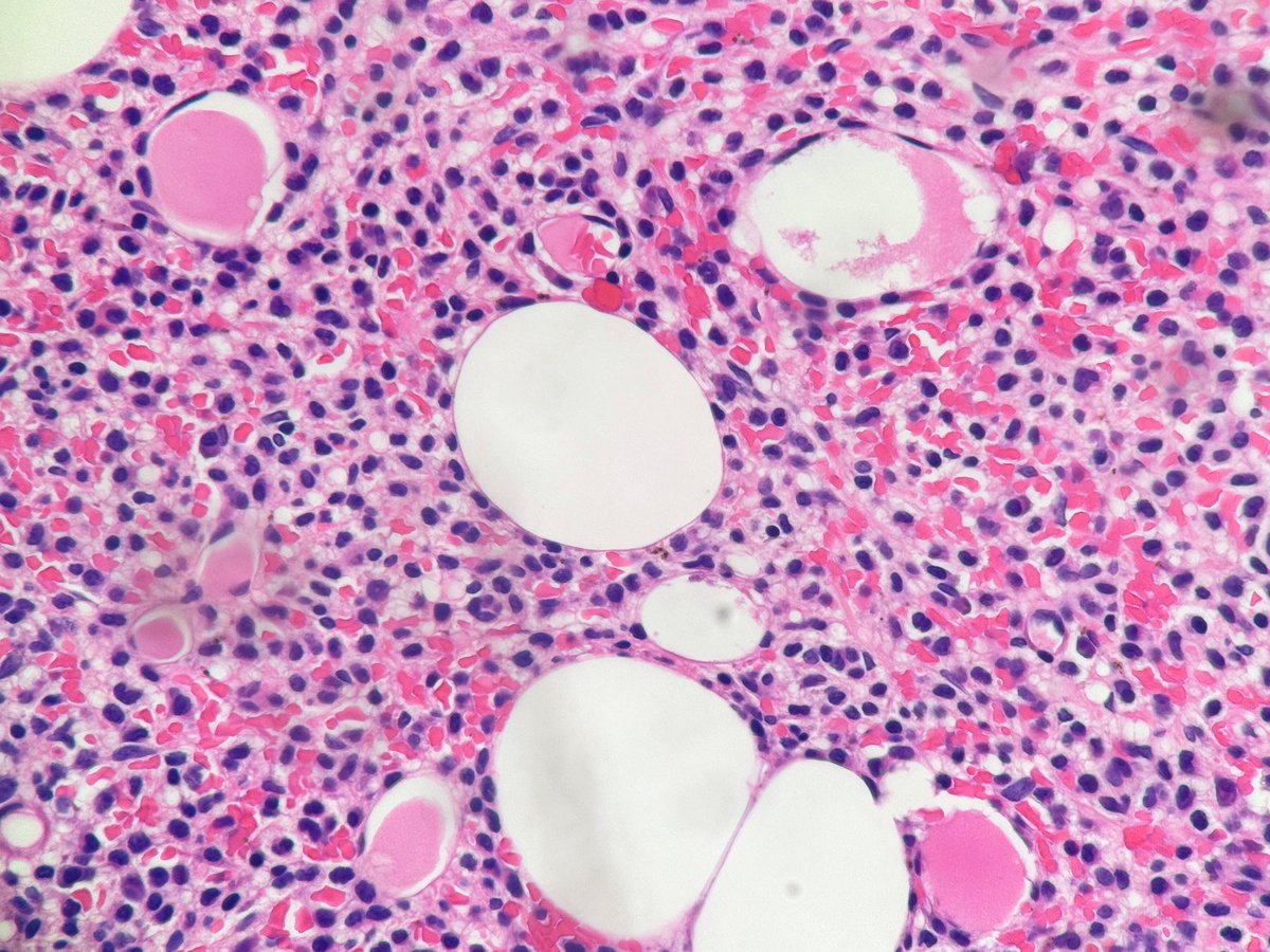 PathologyKate's tweet image. Pancytopenia and dry tap.
