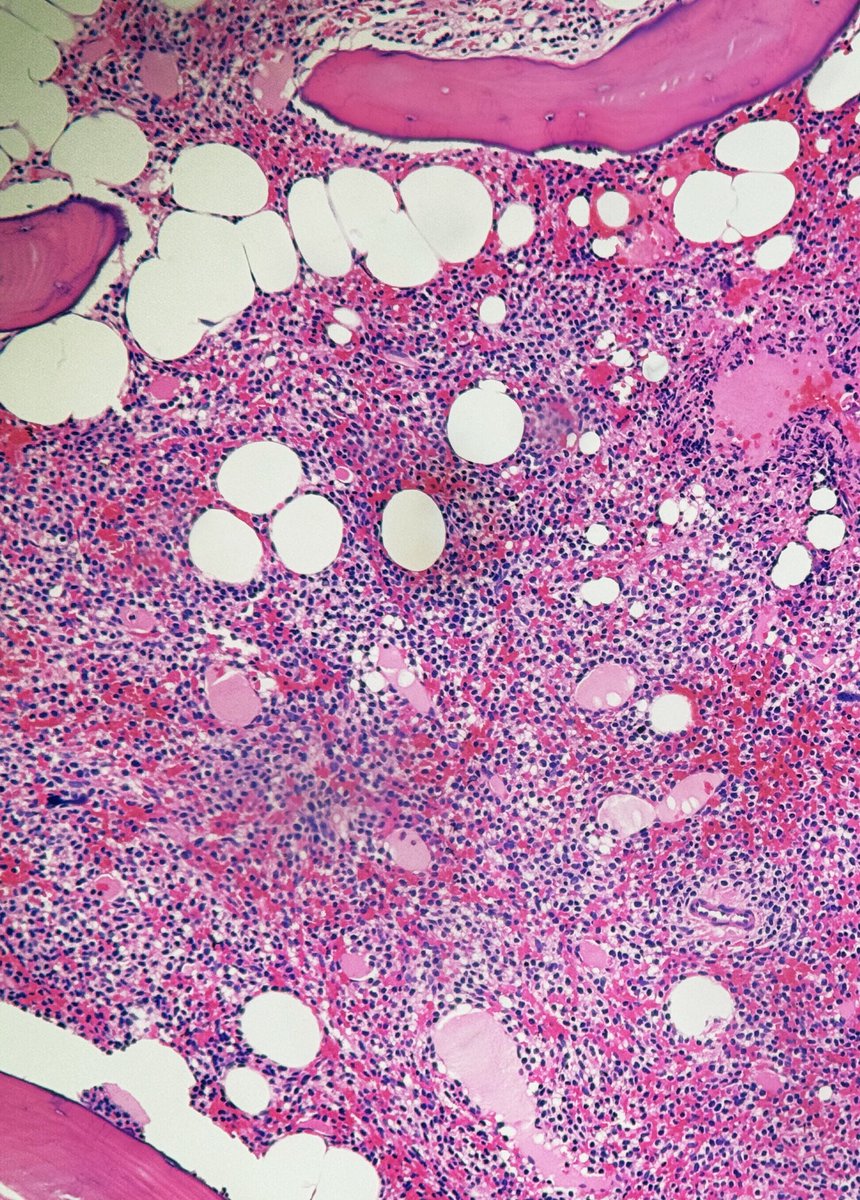 PathologyKate's tweet image. Pancytopenia and dry tap.