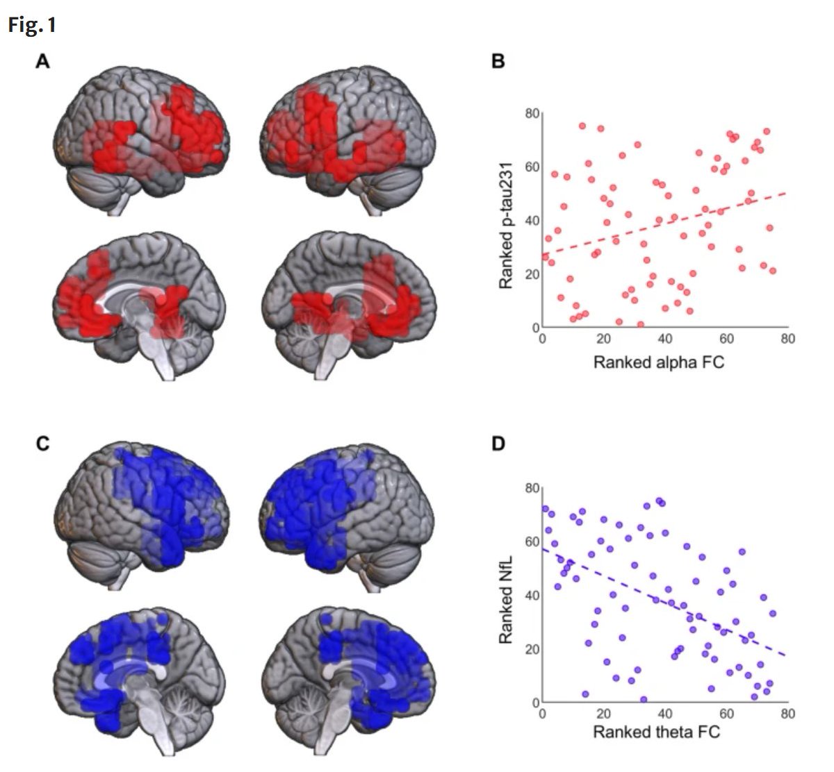 GeroScienceAGE's tweet photo. 🔥Hot Off the Press- Open🔓 Access

Plasma p-tau231 and NfL differently associate with functional connectivity patterns in cognitively unimpaired individuals by Alejandra García-Colomo & Fernando Maestú et al.

https://t.co/g897QKJocZ

#Magnetoencephalograpy #plasmabiomarkers #CognitiveFunction #Alphahyperconnectivity #Thetahypoconnectivity #alzheimersdisease #neurodegeneration