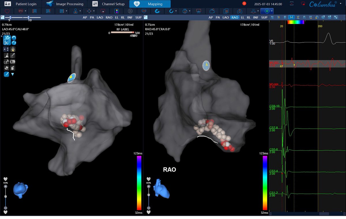 First cases of EP in Lanzarote. Columbus mapping system, so proud of our team! H. José Molina Orosa. Special thanks to Dr. Carlos Vazquez and Dr. Martin Garcia. #ePeeps <a href="/mese79/">Jose M. Meseguer</a>