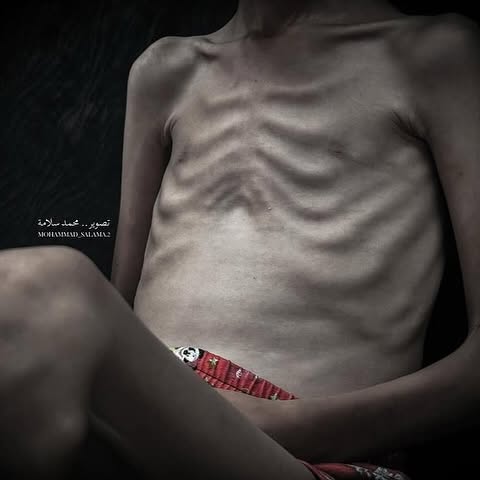 Amal is one of thousands of children in Gaza facing the threat of hunger and malnutrition under a suffocating blockade and severe shortages of food, water, and medicine.