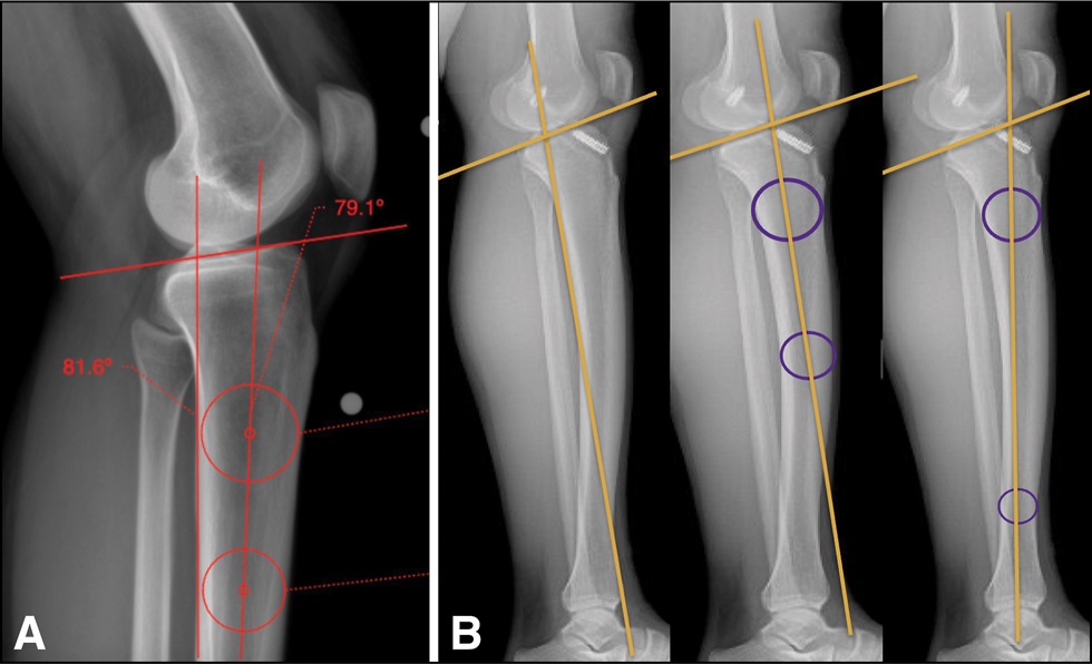 Unveiling the key takeaways from: “FATAL Graft”: A Diagnostic Algorithm for the Workup of Anterior Cruciate Ligament Reconstruction Graft Failure. bit.ly/45CoGam