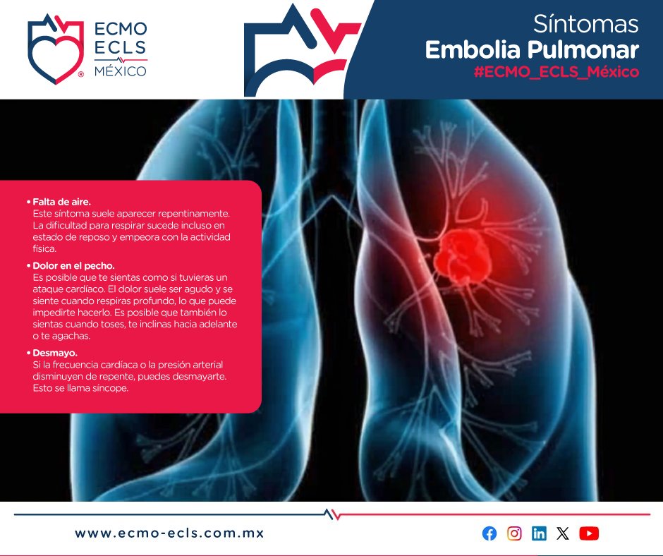 EcmoMexico's tweet photo. #ConocimientoECMO
¿Sabes cuáles son los síntomas de la embolia pulmonar?
#ECMO_ECLS_México #SalvandoVidas #TerapiaECMO #Chihuahua #Gdl #CDMX #EmboliaPulmonar
#AtenciónECMO
Urgencias, atención y traslados 24/7
☎ GDL 33 2332 6342
☎ CDMX 55 7662 3520
☎ Chihuahua 61 4529 7585 https://t.co/yH02SmqJRY