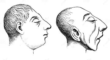MillerFrie84's tweet photo. @InterspeciesFa1 It might’ve been iodine deficiency. See how congenital/natal deficiency deforms the areas of the jaw and forehead.
I believe our view of the Flores population is also confused because of one sickly specimen (it became an absolute question of either sick Sapien OR healthy Erectus) https://t.co/DJ7iC7WqTo