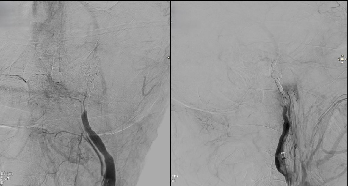 Massive epistaxis by to carotid blowout syndrome due to a ruptured internal carotid artery (ICA) pseudoaneurysm, secondary to nasopharyngeal squamous cell carcinoma (T2N1M0).
Treatment: ICA sacrifice with proximal balloon-assisted coils and glue (NBCA).
<a href="/Coco57489011/">Coco</a>
<a href="/IanJanke/">Ian Janke</a>