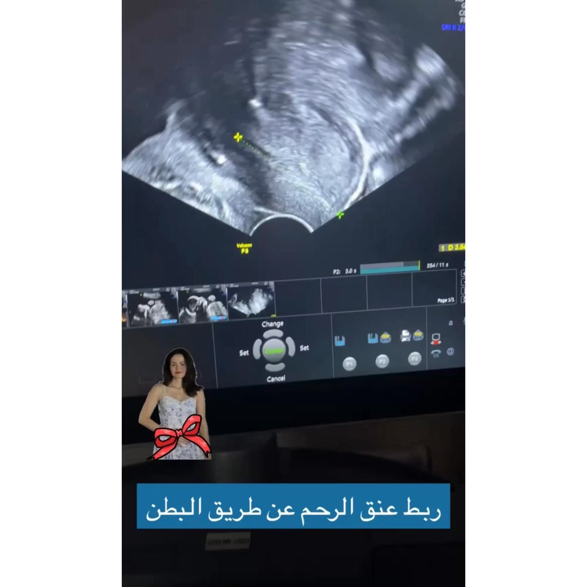 FawazEdris's tweet photo. رابط الڤيديو👇🏻
https://t.co/deIkn5yrjC
.
#حملك #ولاده #ولادتي #توليد #كتاب_حملك_ب��ساطة #توأم #توائم #أطباء #هيلث_بلاس #حامل #حوامل #حملي #انجاب #طفل_انبوب #بنون #عنق_الرحم #قياس_طول_عنق_الرحم #هيلث_بلاس #ربط_عنق_الرحم_من_البطن #ربط_عنق_الرحم #الاجهاض #طول_عنق_الرحم #فواز_ادريس https://t.co/usMF2LV1Ra