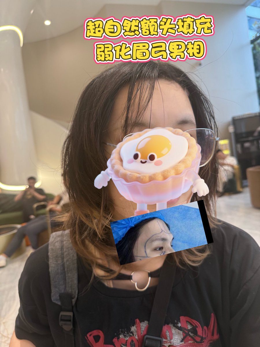 【术后第二天】mtf姐妹肋骨内推➕自体脂肪丰胯（抽大腿妈妈臀脂肪）➕额头填充弱化眉弓

+v bethebeauty12345 領取內部底價表 （私信不回復）MTF 面部女性化隆胸豐臀抽脂皮膚科牙科磨骨
咨询v：bethebeauty12345 

mtf #ts #雌二醇 #雌激素 #补佳乐