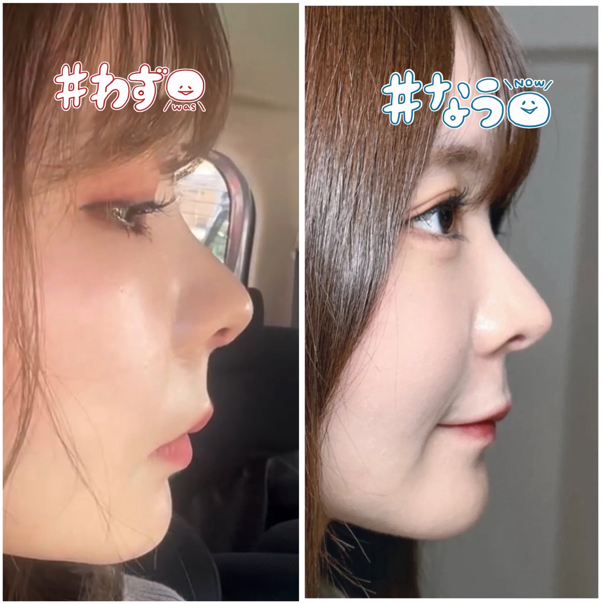 k_peru07285's tweet photo. 【鼻整形後のアップノーズ】
鼻DT中の方からよく聞かれるんだけど
術後の極端なアップノーズは、いずれ下がってくるから心配な気持ちはわかるけど安心して欲しい🥹

術後9日 ▶︎ 3ヶ目 https://t.co/Pj3xDpdHD9