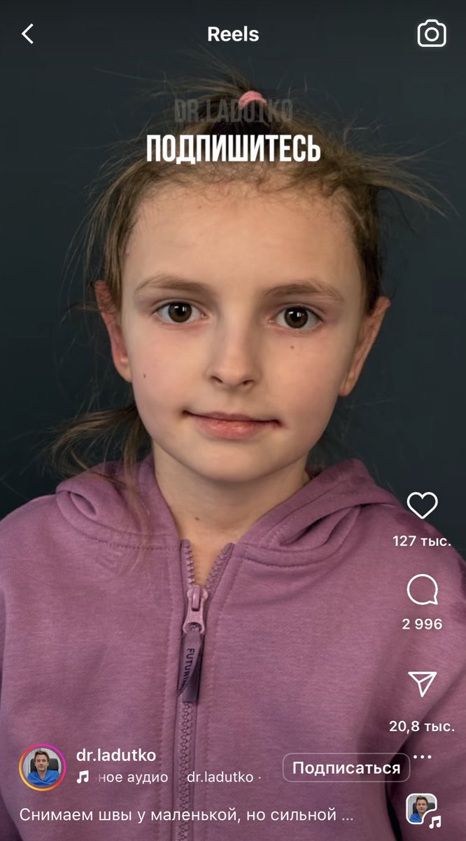 fieva9's tweet image. Вот это меня честно расстраивает. Можно было бы моделью быть с такими ушами, очень гармонично и круто выглядело до. Подвергать такой операции ребенка… чтобы в школе не травили? быть как все? Лишь бы не выделяться? Можно ли в ее возрасте самостоятельно принимать такие решения?