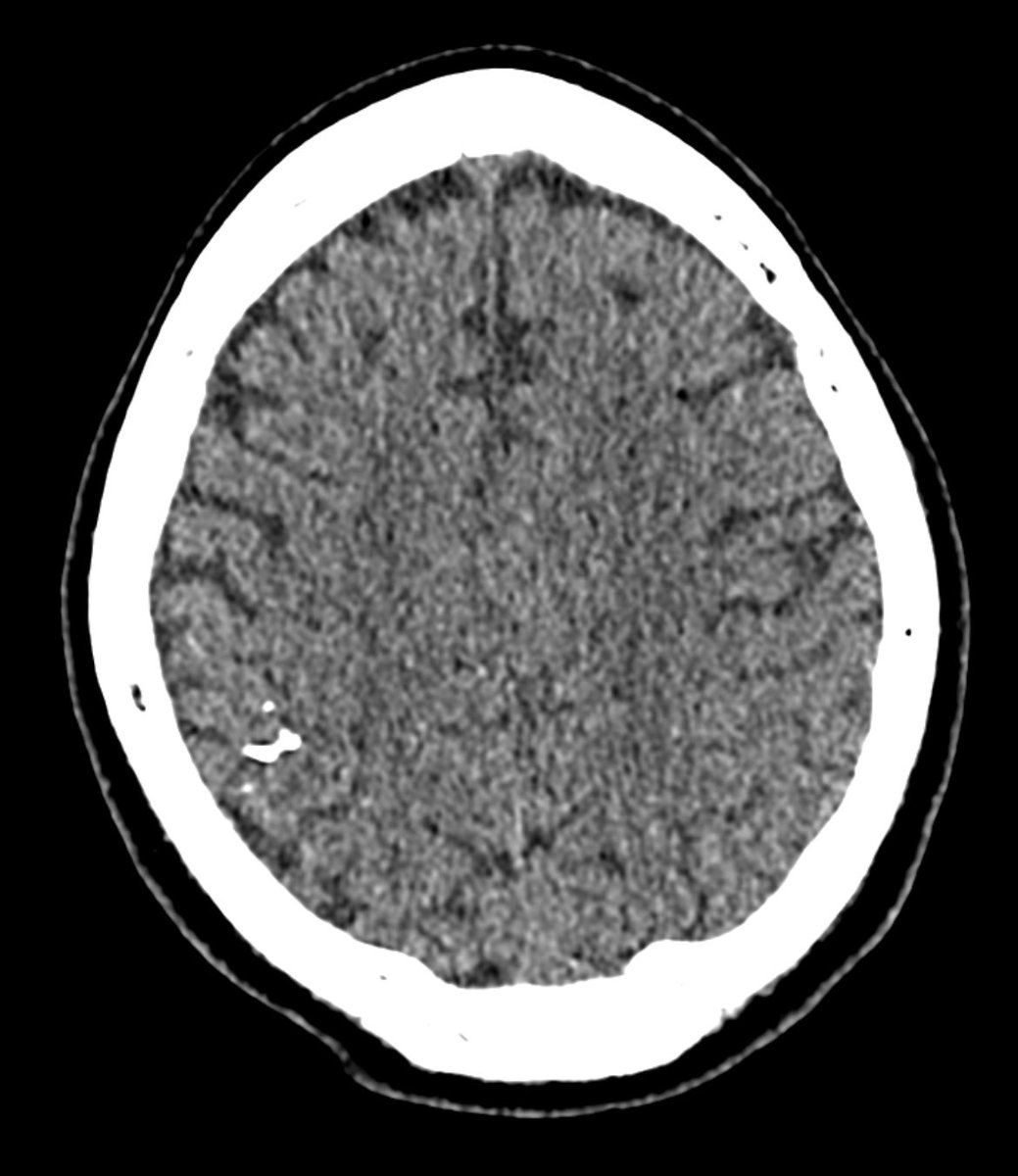 Mycotic (infectious) cerebral aneurysm (CA) resulting from infection of the arterial wall secondary to bacterial endocarditis. Represent &lt; 5% of all CA
We treated it with endovascular glue (NBCA) embolization, complete closure, no deficit
<a href="/Sremollo/">Sebastià Remollo</a> 
<a href="/IsaRCaamano/">Isa</a> 
Rosa García Sort