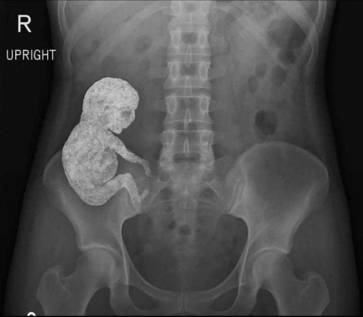 How do you explain this abdominal X-ray taken in a 74 year old woman?