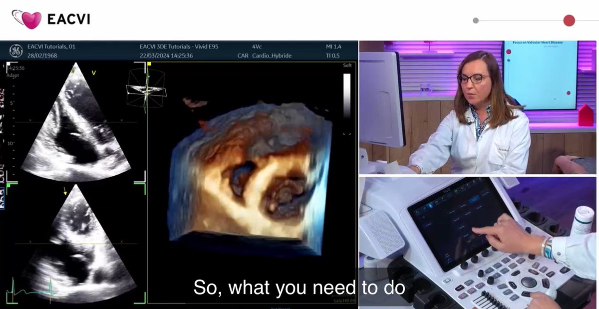 Denisa Muraru (@denisamuraru) on Twitter photo A crucial part of the TR evaluation is the visualization of TV leaflet anatomy.
If you need to learn how to obtain quality 3D views by #echofirst check the #EACVI tutorials on #VHD that will show you all the tips you need to know
bit.ly/44cBp0W
<a href="/EACVIPresident/">EACVI President</a> A crucial part of the TR evaluation is the visualization of TV leaflet anatomy.
If you need to learn how to obtain quality 3D views by #echofirst check the #EACVI tutorials on #VHD that will show you all the tips you need to know
bit.ly/44cBp0W
<a href="/EACVIPresident/">EACVI President</a>