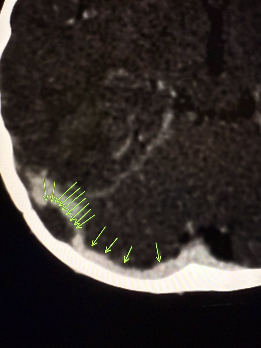 On contrast-enhanced CT or CT venogram, the transverse sinus should hug the occipital bone throughout its course.

If it’s elevated off the occipital bone, suspect venous sinus thrombosis.

Subtle shift. Big clue.

—Pearls and pitfalls from my reporting list.