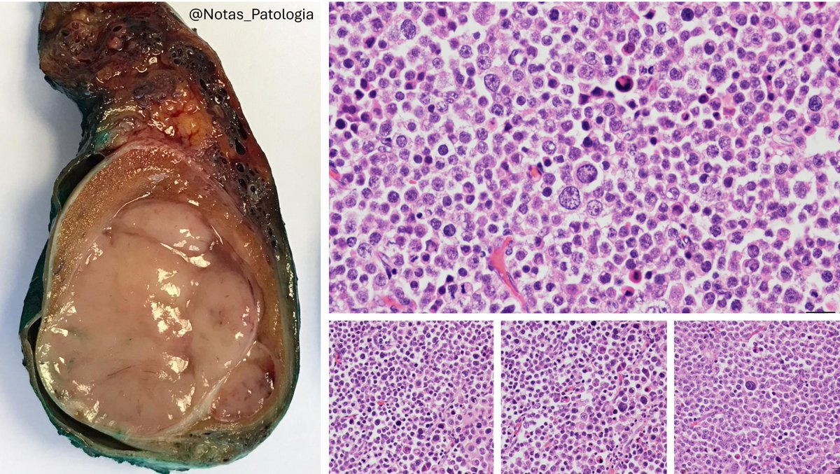 📌 Spermatocytic Tumor (formerly “Spermatocytic Seminoma”) – Key Insights for Pathologists and Urologists

🔬 A rare germ cell tumor (&lt;1% of testicular neoplasms), typically affecting men over 50 years old. Unlike classical seminoma, it is not associated with germ cell neoplasia
