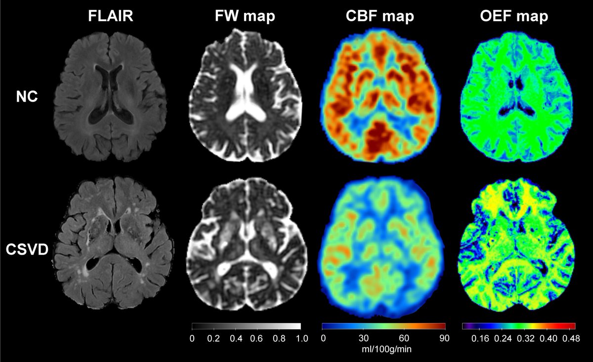 Zhang et al. show that in cerebral small vessel disease, the oxygen extraction fraction first increases and then decreases, suggesting an initial compensatory response that gradually fails with disease progression. tinyurl.com/3ckfnmdh