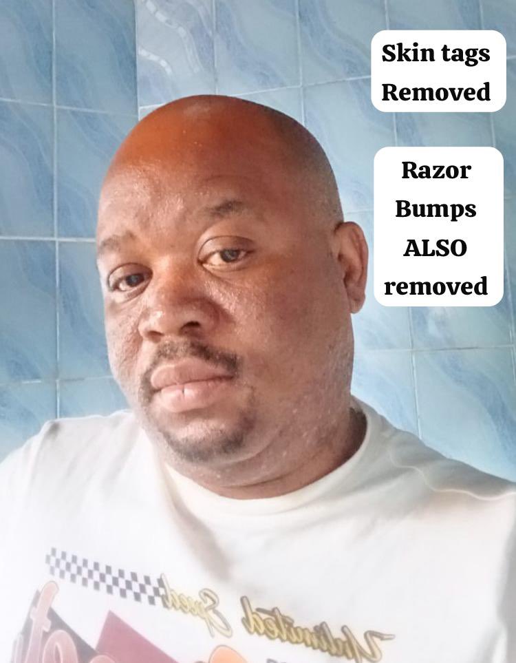 iamsbmazwi's tweet photo. Quick| Pain-free | SKIN TAG REMOVAL
Appointments available ☎️ 0615885177 [Sibu| PE | Gqeberha ] #skintagremoval #nomoreskintags #nomoreiintsumpa #nomorerazorbumps #bumpfreeskin #nelsonmandelabay #gqeberha #clearkin https://t.co/Hkrgj9klya