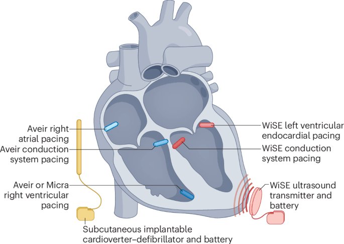 🔴Leadless and extravascular cardiac resynchronization therapy: the future for CRT?⤵️ #2025Review  <a href="/NatRevCardiol/">Nature Reviews Cardiology</a> 

🔹nature.com/articles/s4156… 
 #Cardiology #FOAMed #MedEd #medstudent #paramedic #Cardiology #CardioEd #medtwitter #meded #CardioTwitter #cardiotwiteros