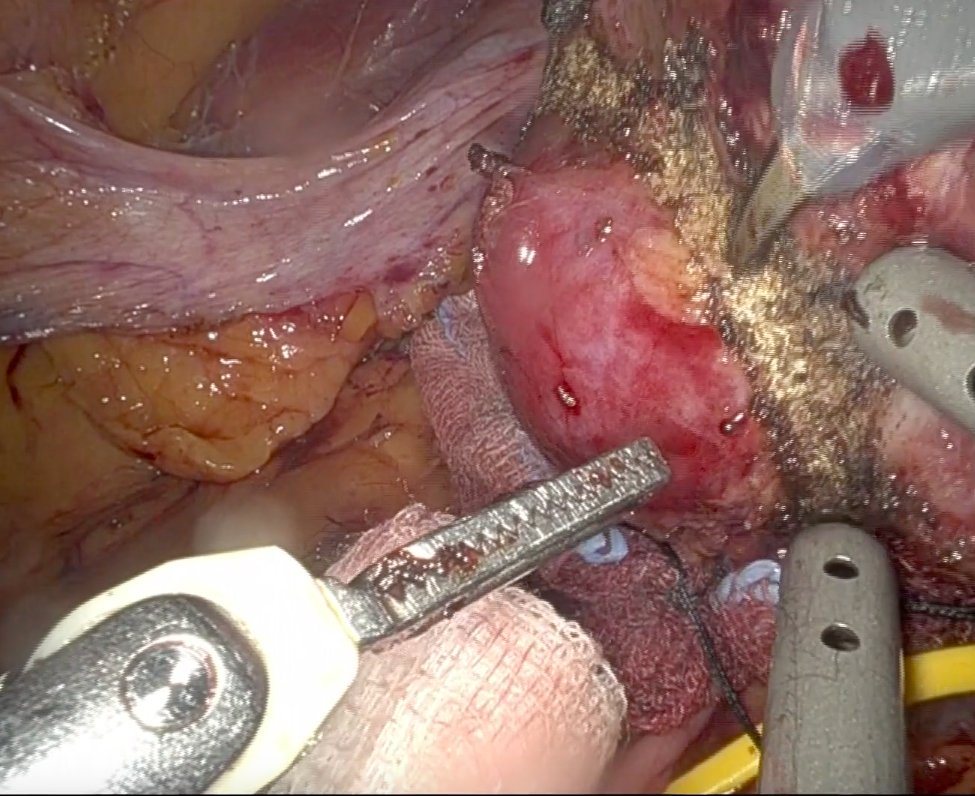 Sciarra Urology (@sciarraurology) on Twitter photo linkedin.com/posts/alessand… <a href="/SapienzaRoma/">Sapienza Università di Roma</a>  <a href="/PoliclinicoUmb1/">Policlinico Umberto I</a> linkedin.com/posts/alessand… <a href="/SapienzaRoma/">Sapienza Università di Roma</a>  <a href="/PoliclinicoUmb1/">Policlinico Umberto I</a>