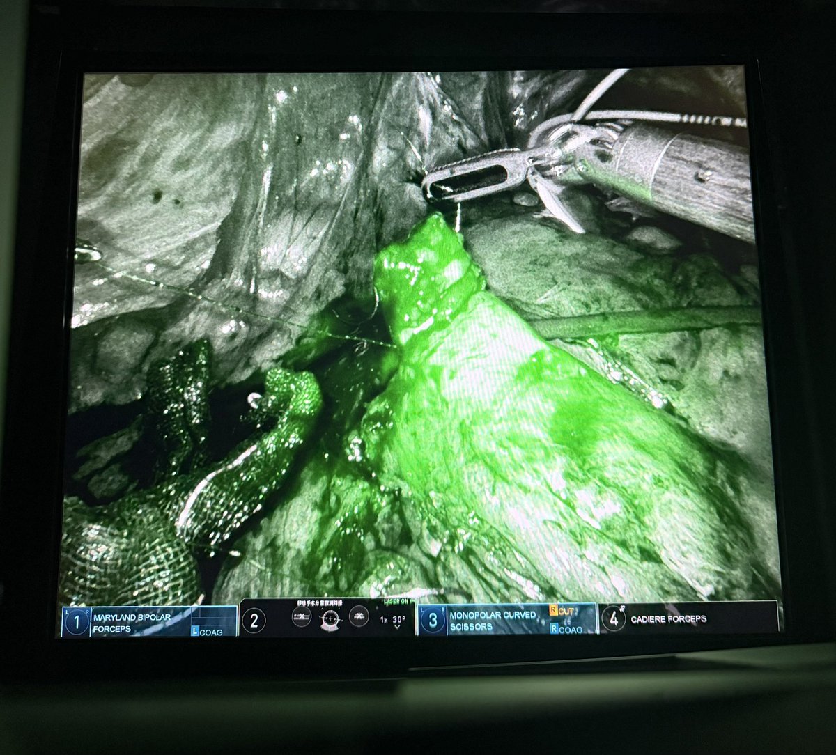 Totally intracorporeal ileal conduit.

Fast recovery and very minimal invasive