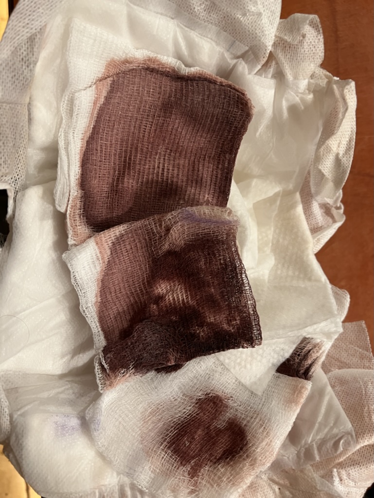 ParallaxAngle's tweet image. vs what happened in Brasil... Feeling very lucky that my hot air balloon crash only resulted in a torn shoulder rotator cuff