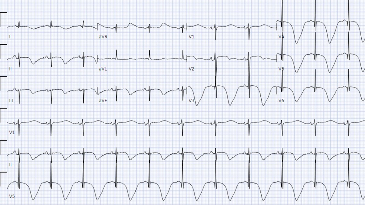 UC San Diego Cardiology Fellows (@ucsdcardfellows) on Twitter photo A new #UCSDCardiologyCases from rising 2nd year <a href="/UCSDCardiology/">UC San Diego Cardiology</a> fellow Dr. Shelief Robbins-Juarez! Middle aged female presents to ED w/ confusion & nausea. Last known normal 1 wk ago. Per sister, "manic-like" & not sleeping. No CP/SOB. Here's the ECG... #CardioTwitter A new #UCSDCardiologyCases from rising 2nd year <a href="/UCSDCardiology/">UC San Diego Cardiology</a> fellow Dr. Shelief Robbins-Juarez! Middle aged female presents to ED w/ confusion & nausea. Last known normal 1 wk ago. Per sister, "manic-like" & not sleeping. No CP/SOB. Here's the ECG... #CardioTwitter