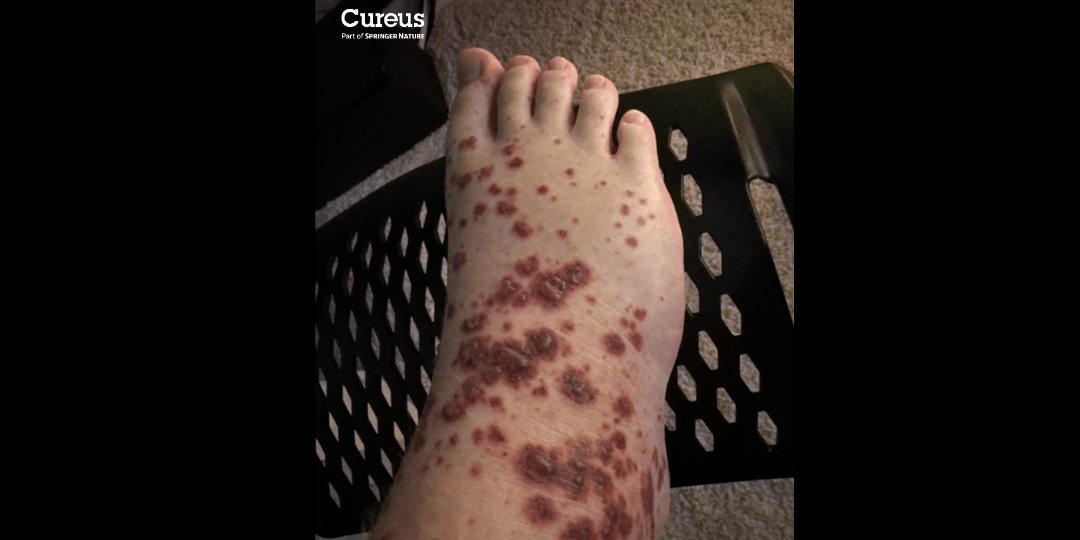CureusNeuro (@cureusneuro) on Twitter photo Can you diagnose this rash?
A 14-year-old with palpable purpura, necrotic centers & abdominal pain. Biopsy shows leukocytoclastic vasculitis.
Drop your answer below or take the full quiz here: hubs.la/Q03t4_RN0
#MedEd #Cureus #Dermatology #Vasculitis Can you diagnose this rash?
A 14-year-old with palpable purpura, necrotic centers & abdominal pain. Biopsy shows leukocytoclastic vasculitis.
Drop your answer below or take the full quiz here: hubs.la/Q03t4_RN0
#MedEd #Cureus #Dermatology #Vasculitis