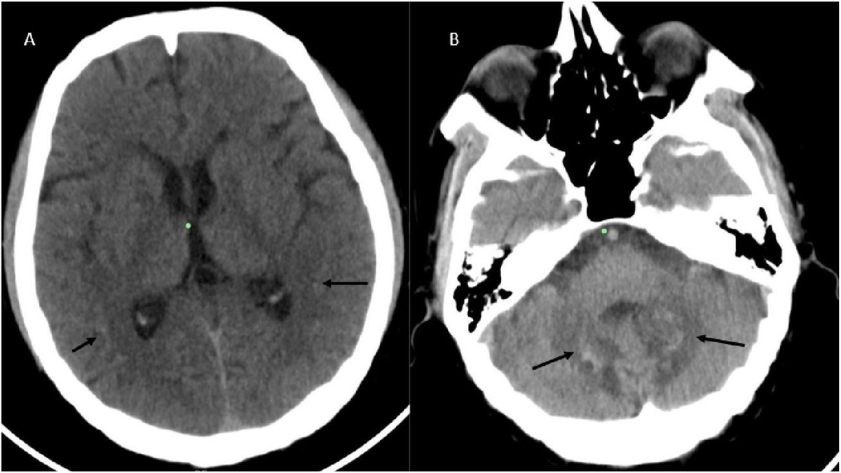 ParkinsonismD's tweet image. #casereport #dentatecalcification #palataltremor #facialmyorhythmia #adrenoleukodystrophy #ALD
@PRDAssociation
Log in for video and full article:
prd-journal.com/article/S1353-…