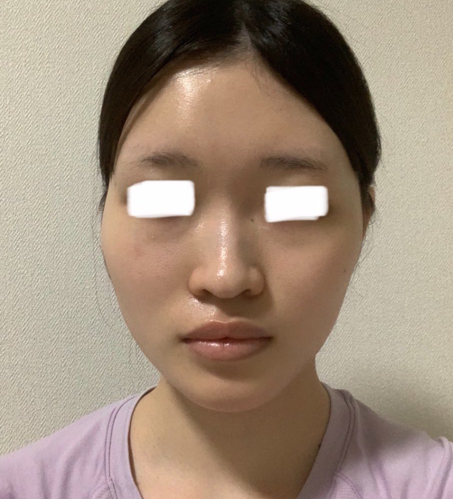 1枚目:未整形
2枚目:整形後
(輪郭3点DT6ヶ月、鼻整形DT10ヶ月)
同じ髪型にすると輪郭の変化が分かりやすい🥹これからも自分なりにアップデートしていくわよ〜^_^ https://t.co/kLtB6P6NQc