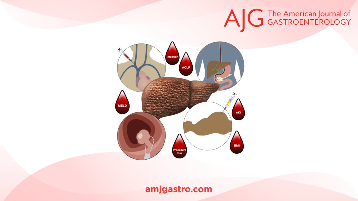 AJG - The American Journal of Gastroenterology (@amjgastro) on Twitter photo Predicting and Preventing Bleeding in Patients With Cirrhosis Undergoing Procedures
Erno, et al.
📕 bit.ly/3Tyvyhz
<a href="/MLongMD/">Millie Long</a> <a href="/JasmohanBajaj/">Jasmohan Bajaj</a> Predicting and Preventing Bleeding in Patients With Cirrhosis Undergoing Procedures
Erno, et al.
📕 bit.ly/3Tyvyhz
<a href="/MLongMD/">Millie Long</a> <a href="/JasmohanBajaj/">Jasmohan Bajaj</a>