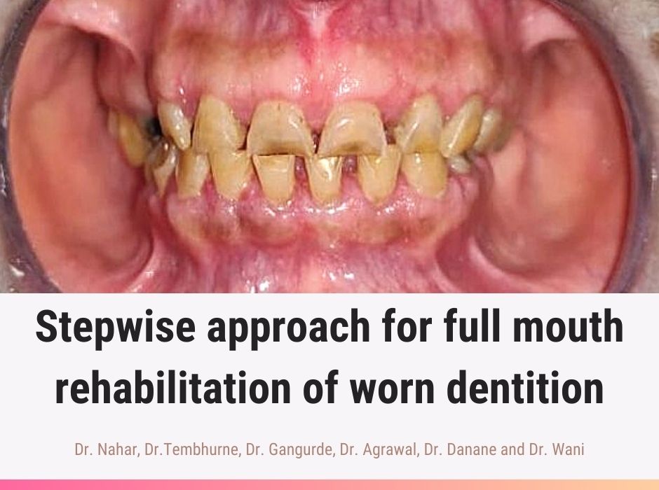 PDF odontologiavirtual.com/2024/01/pdf-st…

This case report describes treatment protocol for a 62-year-old female with severely worn-out dentition, partial edentulism and lost anterior guidance.

A fixed permanent restoration of the occlusion was planned with appropriate planning and analysis.
