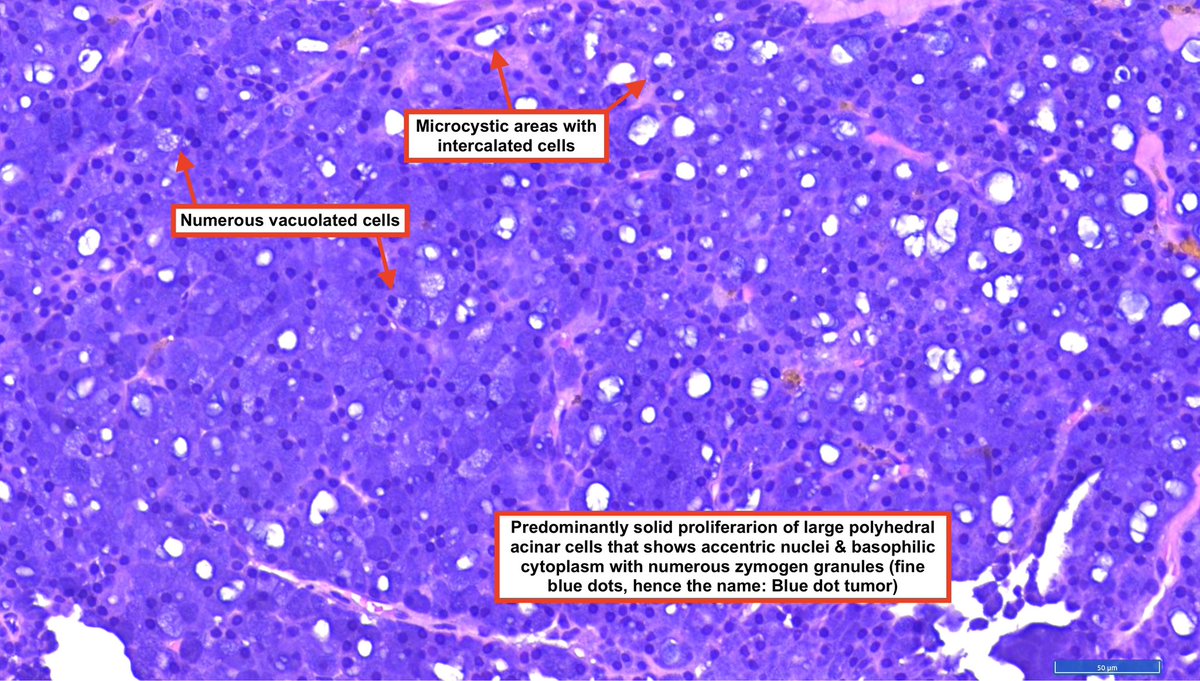 Hashimoto__0's tweet image. Acinic cell carcinoma