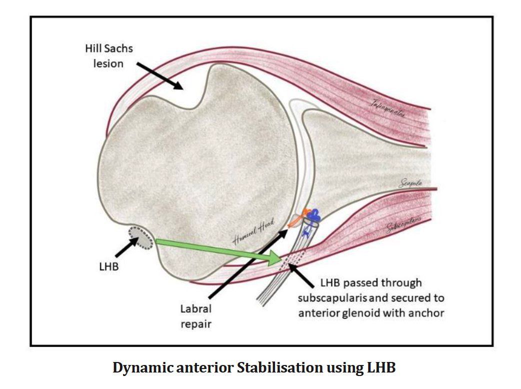 MoAImam's tweet photo. the BoTH classification for shoulder instability. This system focuses on three key aspects:

Bo: Bone loss
T: Condition of soft tissue
H: Hill-Sachs lesion (a type of bone injury that occurs in some cases of shoulder dislocation)
By incorporating these modern techniques, the BoTH classification system provides a more comprehensive approach to determining the best treatment path for each patient.

Read the whole paper: https://t.co/uL6qkOhThA