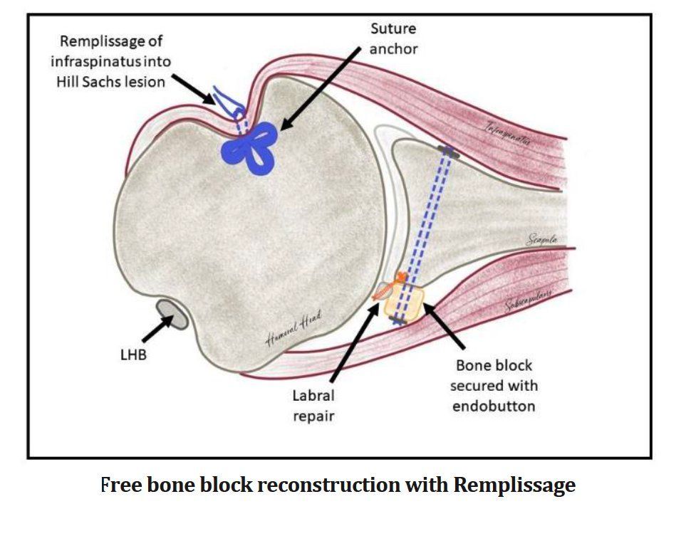 MoAImam's tweet photo. the BoTH classification for shoulder instability. This system focuses on three key aspects:

Bo: Bone loss
T: Condition of soft tissue
H: Hill-Sachs lesion (a type of bone injury that occurs in some cases of shoulder dislocation)
By incorporating these modern techniques, the BoTH classification system provides a more comprehensive approach to determining the best treatment path for each patient.

Read the whole paper: https://t.co/uL6qkOhThA