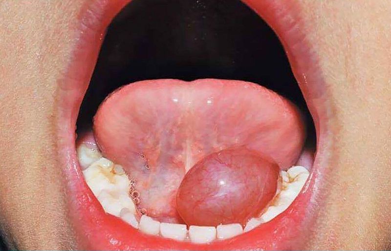 PDF odontologiavirtual.com/2019/01/pdf-co…

Ranulas have been managed by marsupialization, excision of the lesion, excision of the sublingual gland, or combined excision of both the ranula and the sublingual gland. 

Treatments that do not include removal of the involved sublingual gland, such