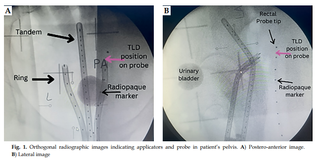 High-dose-rate intracavitary brachytherapy delivers high radiation doses to tumors while minimizing exposure to surrounding normal cells.
termedia.pl/Assessment-of-…