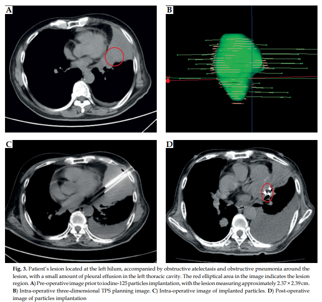 This study aimed to explore the risk factors associated with difficult-to-control pain (visual analog scale [VAS] score > 3) experienced by patients with advanced non-small cell lung cancer (NSCLC) 

termedia.pl/Evaluation-of-…