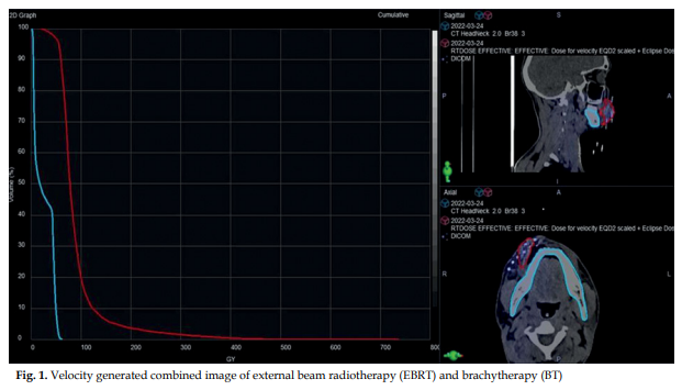Oral cavity squamous cell carcinoma (SCC) is conventionally treated with surgery followed by adjuvant radiation therapy.
termedia.pl/Evaluation-of-…