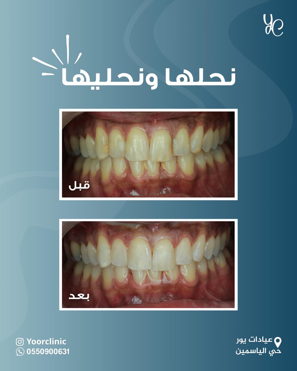 نحلها لك ونحليها🪄
تم عمل حشوات تجميلية لمراجع يشتكي من لون الحشوات السابقة..
لدى عيادة د. محمد العيسى 

للحجز:

📍 عيادات يور – حي الياسمين
📲 0550900631

#يور_كلينك #اسنان #حشوات