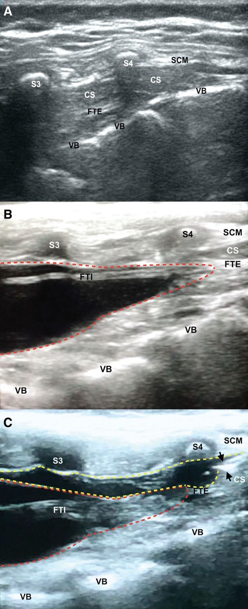 Images in #Anesthesiology - Tethered Spinal Cord Syndrome Discovered during Ultrasound-guided Caudal Block 🖌️ ow.ly/SEiI50Wb1UA