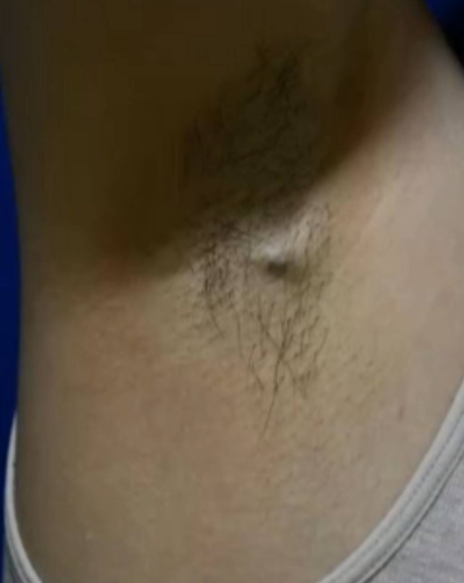 Henry YANG (@henryy_md) on Twitter photo 40 Year old female with right axilla nodule (1.5 cm) for two years. No other systemic issue-tumors, Breast imaging is normal. This lesion is P63 negative.
#dermapth #dermatology
<a href="/glinglerimek/">gulcin guler simsek, MD</a> <a href="/pepeheffernan/">Pepe Jiménez Heffernan</a> <a href="/SGottesmanMD/">Silvija Gottesman MD</a> <a href="/FungMaxwell/">Maxwell Fung, MD</a> <a href="/et565/">Etan Marks, DO</a> <a href="/david_terrano/">David Terrano</a> <a href="/mccalmo/">Tim McCalmont</a> <a href="/tonitatirado/">Mariantonieta Tirado</a> 40 Year old female with right axilla nodule (1.5 cm) for two years. No other systemic issue-tumors, Breast imaging is normal. This lesion is P63 negative.
#dermapth #dermatology
<a href="/glinglerimek/">gulcin guler simsek, MD</a> <a href="/pepeheffernan/">Pepe Jiménez Heffernan</a> <a href="/SGottesmanMD/">Silvija Gottesman MD</a> <a href="/FungMaxwell/">Maxwell Fung, MD</a> <a href="/et565/">Etan Marks, DO</a> <a href="/david_terrano/">David Terrano</a> <a href="/mccalmo/">Tim McCalmont</a> <a href="/tonitatirado/">Mariantonieta Tirado</a>