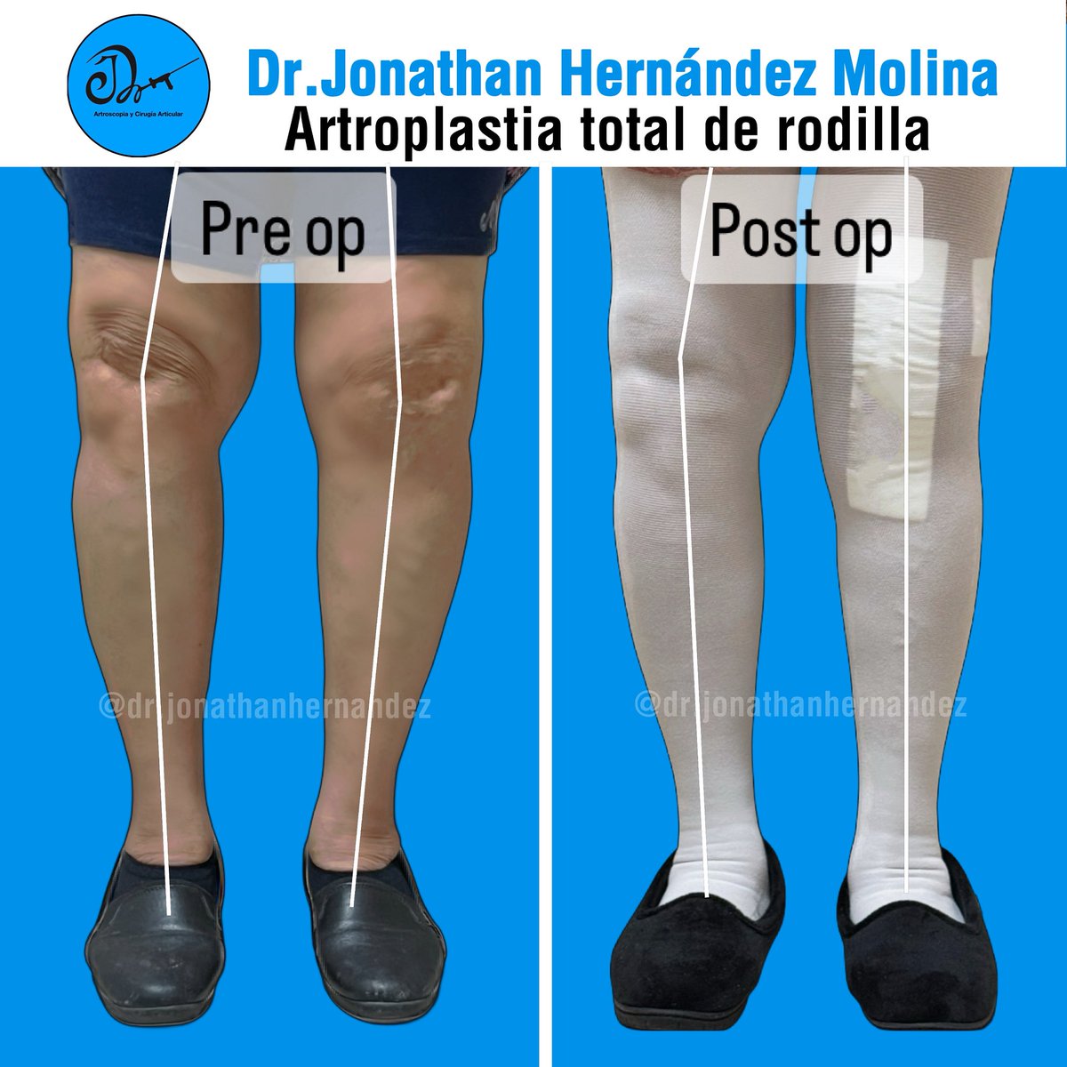 JonathanRubenHM's tweet photo. ARTOPLASTIA TOTAL DE RODILLA
Dr.Jonathan Hernández Molina
Ortopedia | Artroscopia y Cirugía Articular | Robótica
C.E:09062382 UNAM 
COFEPRIS: 2409062002A00046                                  
Citas :5552782601 https://t.co/zS1cC51UJ4