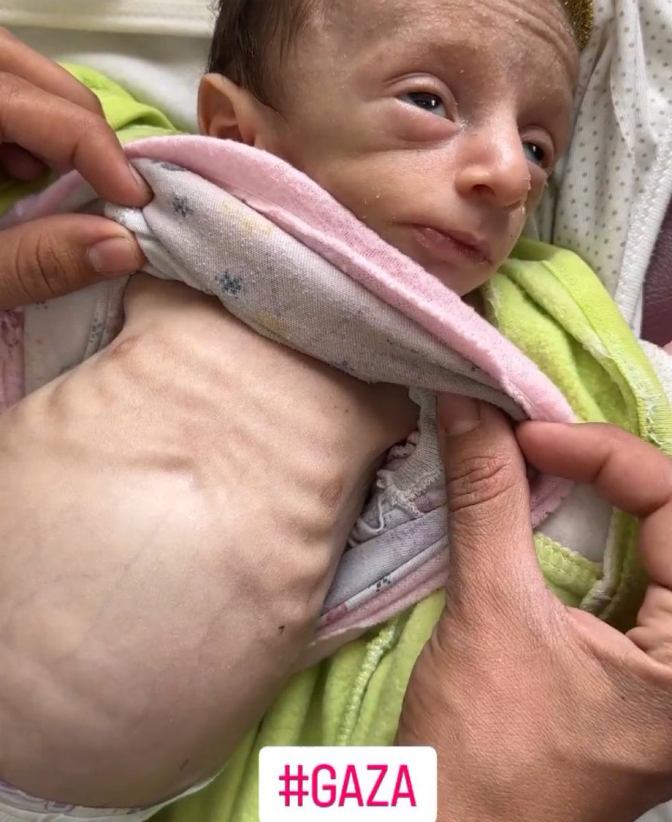 الجوع يفدك اجسام اطفال غزه