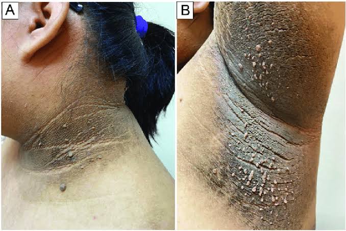 AdarshP12784057's tweet photo. Random Medical Facts #2
No this is not some dirt build up on skin or a person not taking a regular bath, it is a sign that is associated with the higher risk of developing Diabetes Mellitus. 

This is Acanthosis Nigricans. 

#neetpg2025 #inicet2025 #dermpath #MedTwitter #Trending https://t.co/3aCCqAxhWh