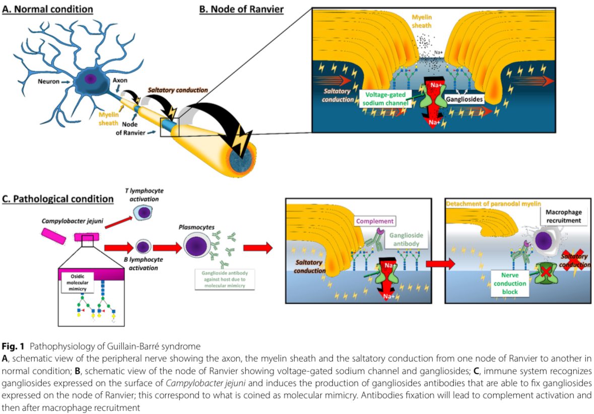 Fisiopatología del síndrome Guillain-Barré:

Annals of Intensive Care 2025; DOI: doi.org/10.1186/s13613…