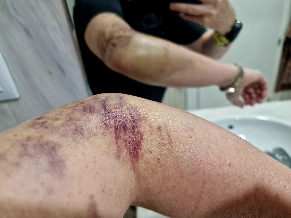 Jali #STOPokupas (@jaliroller) on Twitter photo Hoy tocaba retirada del vendaje y debajo hay lo que cabía esperar, dentro de la suerte que he tenido de que estoy aquí y os lo estoy contando. Durante el fin de semana me han ido apareciendo nuevos hematomas por el cuerpo. Lo dicho, sed prudentes siempre, al volante y como peatón Hoy tocaba retirada del vendaje y debajo hay lo que cabía esperar, dentro de la suerte que he tenido de que estoy aquí y os lo estoy contando. Durante el fin de semana me han ido apareciendo nuevos hematomas por el cuerpo. Lo dicho, sed prudentes siempre, al volante y como peatón