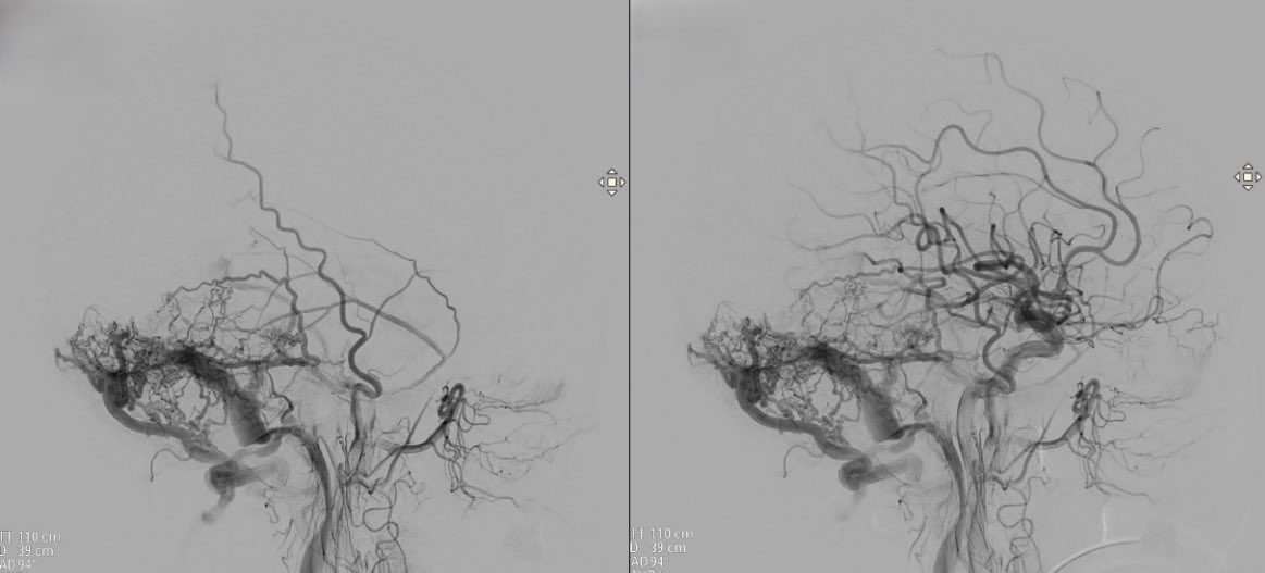 CarlosC74716941's tweet photo. Dural arteriovenous fistula (#DAVF) involving the sigmoid/transverse sinus.
We embolized it with #Squid, using the pressure cooker technique, and assisted with balloon in the sinuses, achieving complete closure, without complications
@Sremollo
@IsaRCaamano
Rosa García-Sort https://t.co/OoShTbvkue