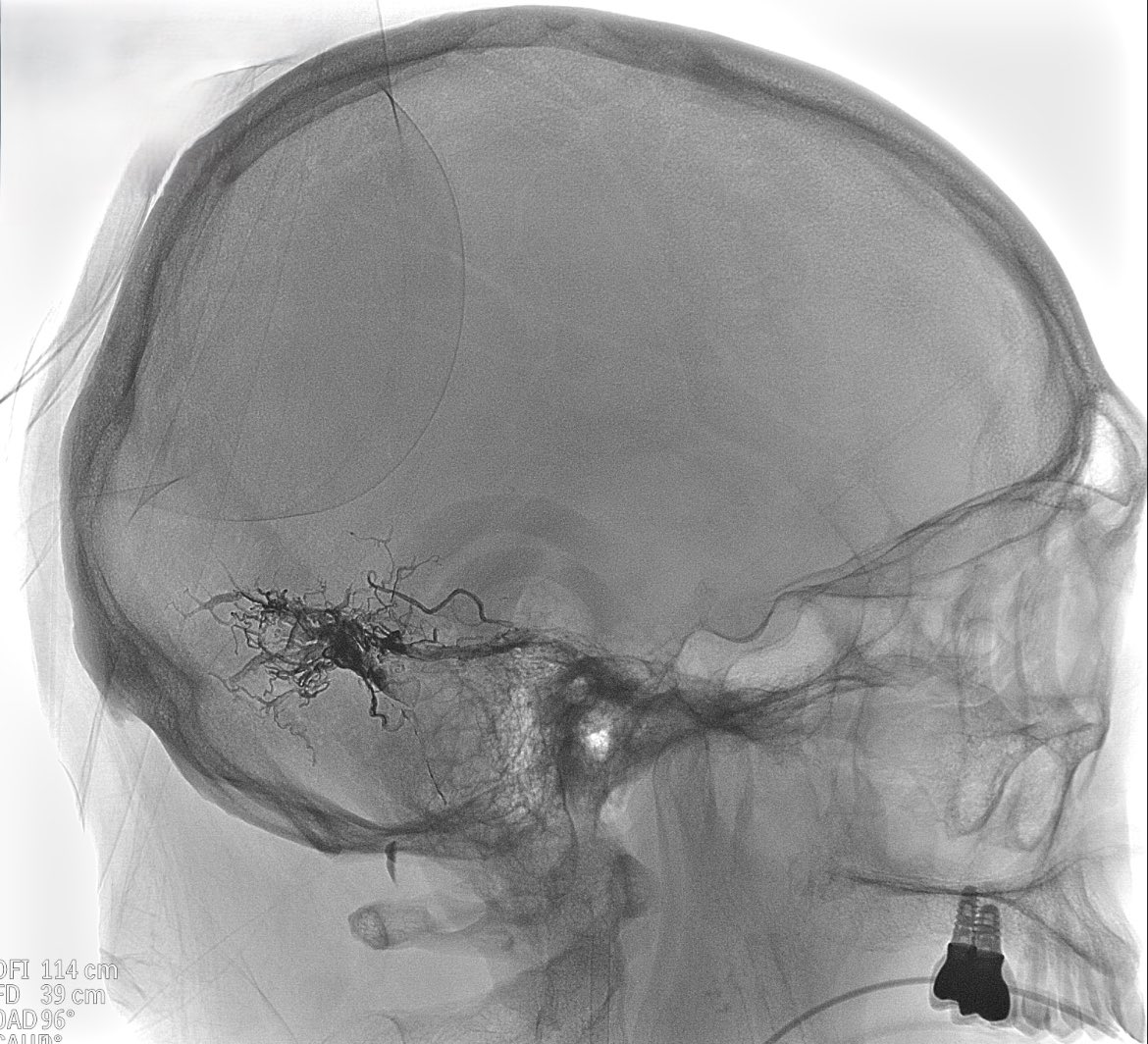 CarlosC74716941's tweet photo. Dural arteriovenous fistula (#DAVF) involving the sigmoid/transverse sinus.
We embolized it with #Squid, using the pressure cooker technique, and assisted with balloon in the sinuses, achieving complete closure, without complications
@Sremollo
@IsaRCaamano
Rosa García-Sort https://t.co/OoShTbvkue