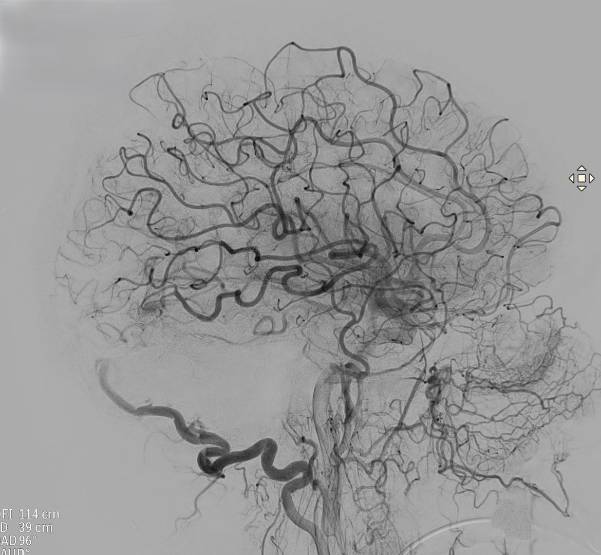 Dural arteriovenous fistula (#DAVF) involving the sigmoid/transverse sinus.
We embolized it with #Squid, using the pressure cooker technique, and assisted with balloon in the sinuses, achieving complete closure, without complications
<a href="/Sremollo/">Sebastià Remollo</a>
<a href="/IsaRCaamano/">Isa</a>
Rosa García-Sort