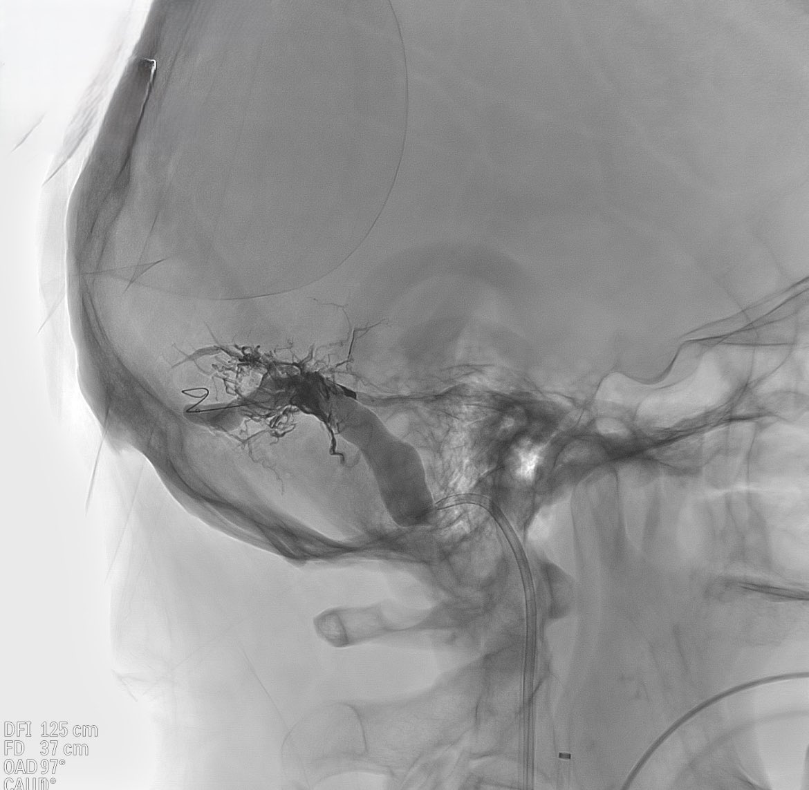 CarlosC74716941's tweet photo. Dural arteriovenous fistula (#DAVF) involving the sigmoid/transverse sinus.
We embolized it with #Squid, using the pressure cooker technique, and assisted with balloon in the sinuses, achieving complete closure, without complications
@Sremollo
@IsaRCaamano
Rosa García-Sort https://t.co/OoShTbvkue